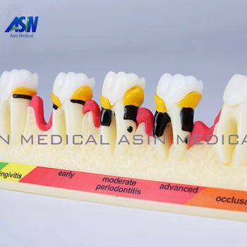 Classification of periodontal diseases teeth model Dental patient communication model process of periodontal disease