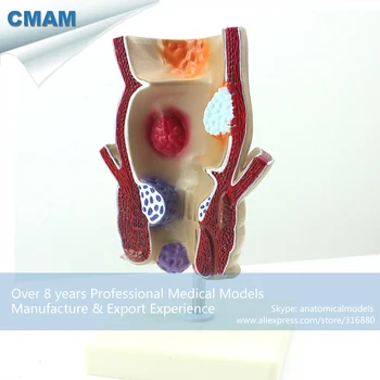CMAM-VISCERA10 Medical Science Human Anatomical Pathological Model of the Rectum