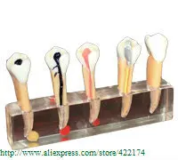 5stage model endodontics treatment dental tooth teeth anatomical anatomy model odontologia
