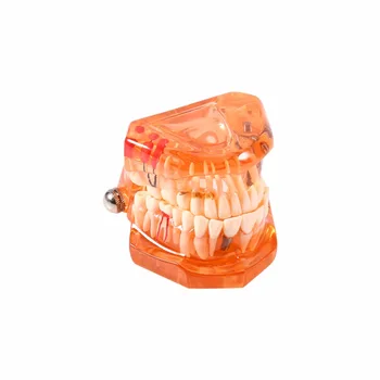 Orange Color 1PC Dental Implant Disease Teeth Model Orange Removable Study Teaching Teeth Model for Medical Science Teaching