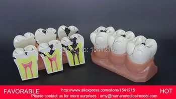 TOOTH DISEASE PATHOLOGICAL ANATOMICAL MODEL OF TEETH CARIES GINGIVAL,4 TIMES THE TOOTH CAVITY DEVELOPMENT MODEL-GASEN-DEN043