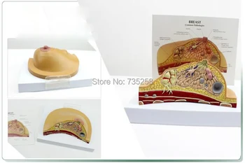 Breast Lesions Anatomical Structure Model,Breast Pathological Lesion of Doctor-Patient Communication Model