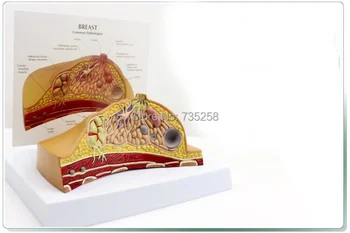 Breast Lesions Anatomical Structure Model,Breast Pathological Lesion of Doctor-Patient Communication Model