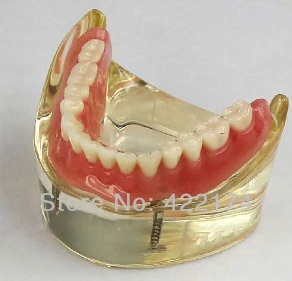 Over denture inferior with 2 implants for dentist communication with patients dental tooth teeth dentistry model