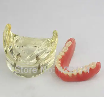 Over denture inferior with 2 implants for dentist communication with patients dental tooth teeth dentistry model