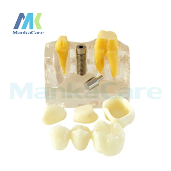 Manka Care - 4Times Implant Model/Made of resin Oral Model Teeth Tooth Model